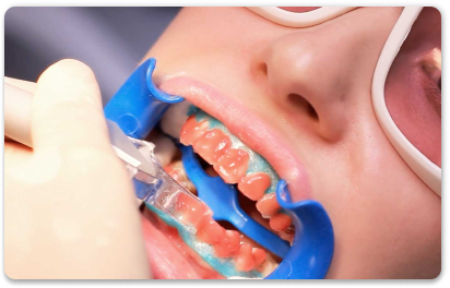 отбеливание зубов лазером