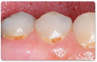 пришеечный кариес детских зубов
