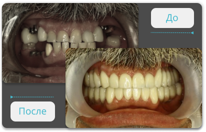 протезирование зубов на имплантах фото до после