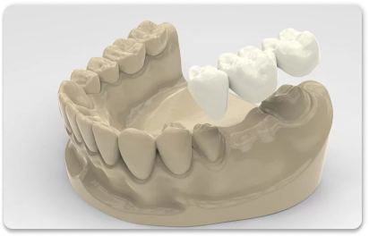 мостовидный протез на жевательные зубы