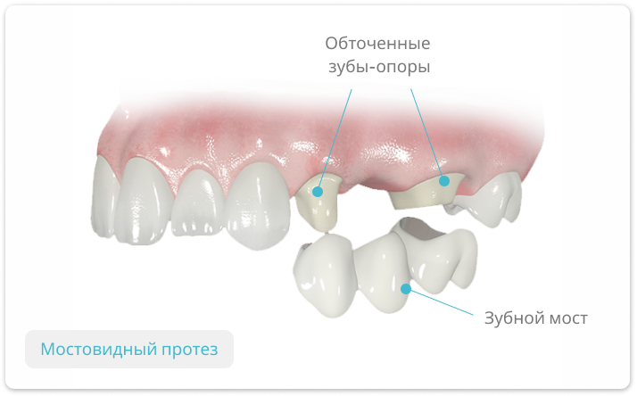 мостовидный протез зубов
