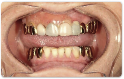зубные коронки из золота
