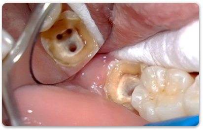 чистка каналов зуба