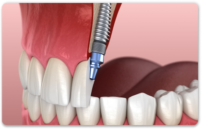 имплантация передний зубов