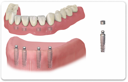 условно-съемный зубной протез на 4 имплантах