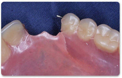 трещина на зубном протезе