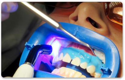 лазерное отбеливание зубов