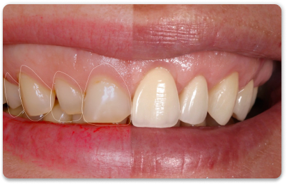 композитные виниры на зубы