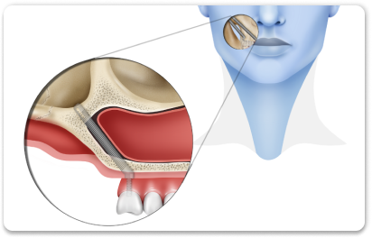скуловая имплантация зубов