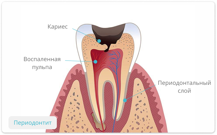 периодонтит зуба