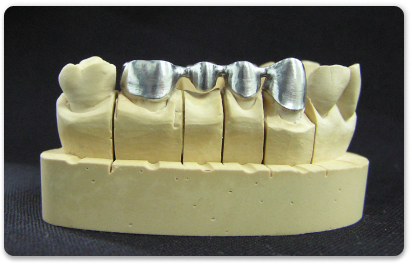 металлический каркас зубного моста