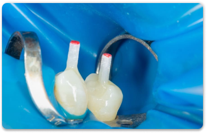 Восстановление зуба пломбой на штифте