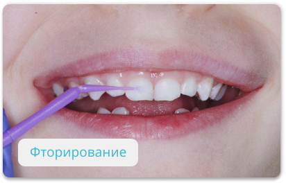 фторирование детских зубов