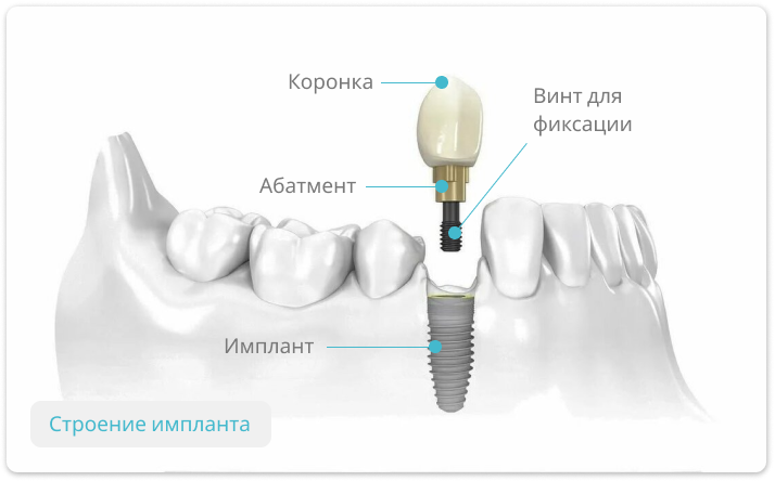 Строение классического импланта зуба