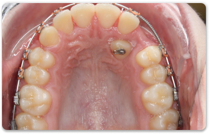 Ортодонтическое лечение ретинированных зубов