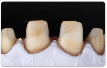 обточка зуба под коронку