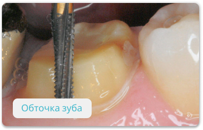 обточка зуба