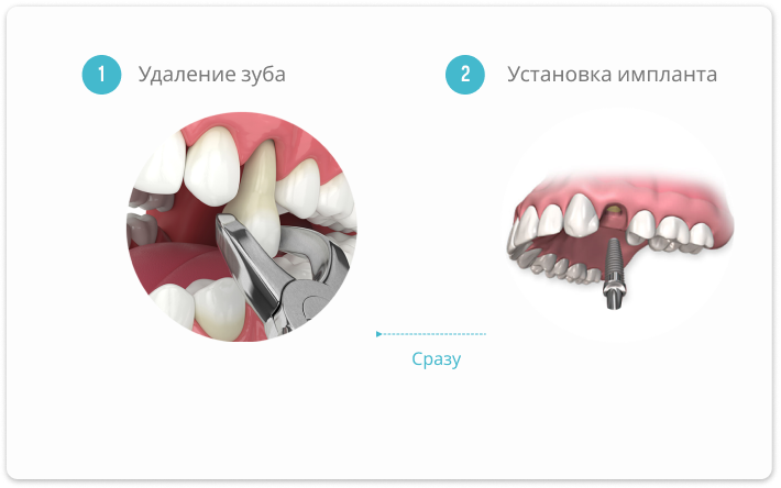 одномоментная имплантация зубов этапы
