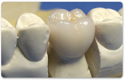 композитная коронка на зуб