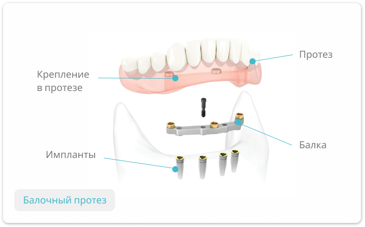 балочный протез зубов