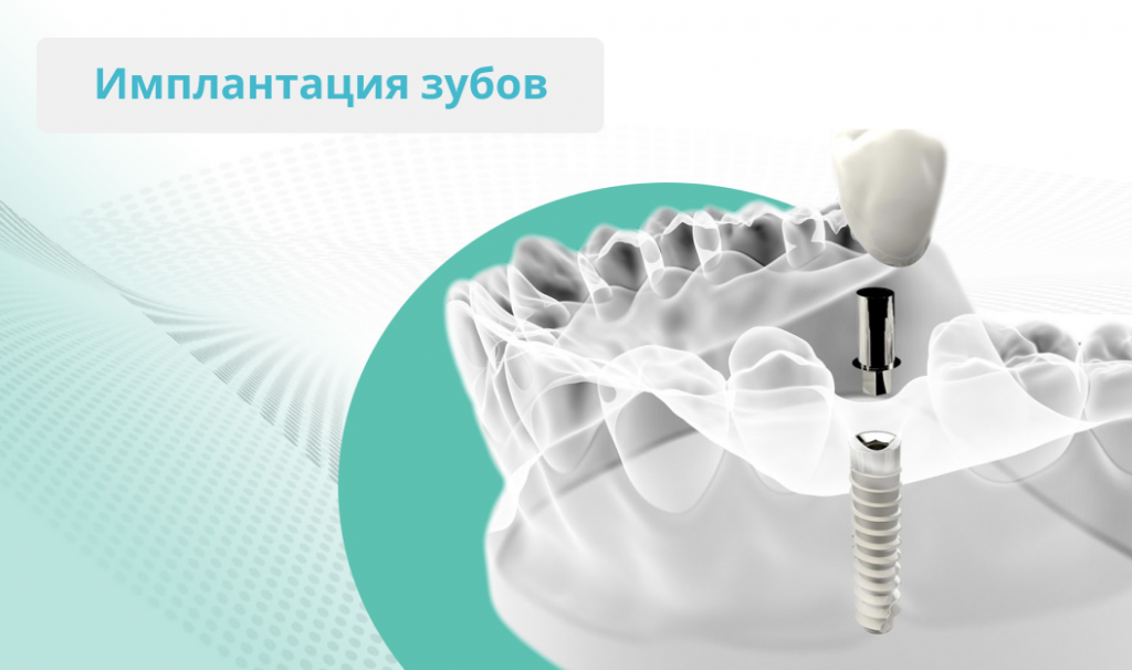 акции на имплантацию зубов
