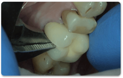 снятие коронки с зуба