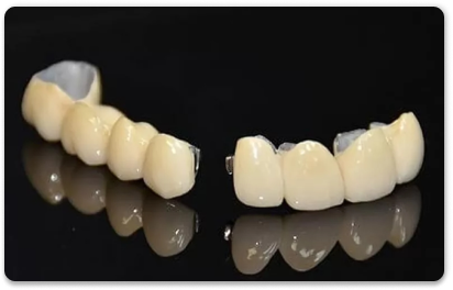 металлопластмассовые коронки на зубы