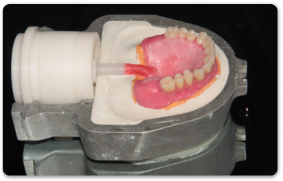 перебазировка протезов зубов
