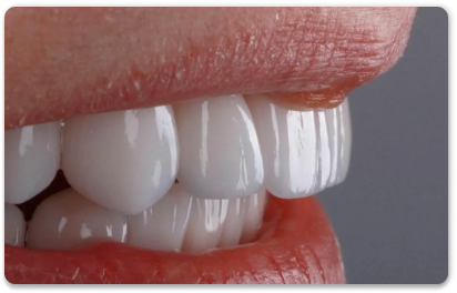 керамические накладки на зубы