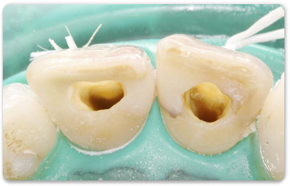 отбеливание каналов зуба