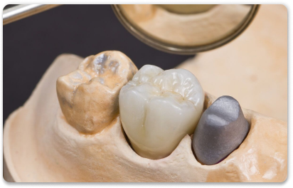 протезирование жевательных зубов