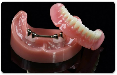съемный зубной протез на имплантах