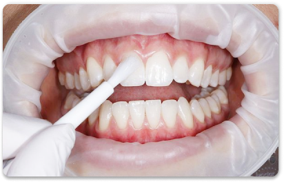 покрытие зубов фтор-лаком