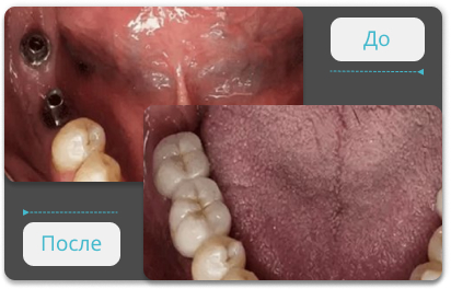 имплантация 2 жевательных зубов