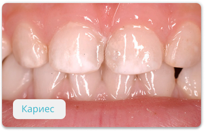 начальный кариес молочных зубов