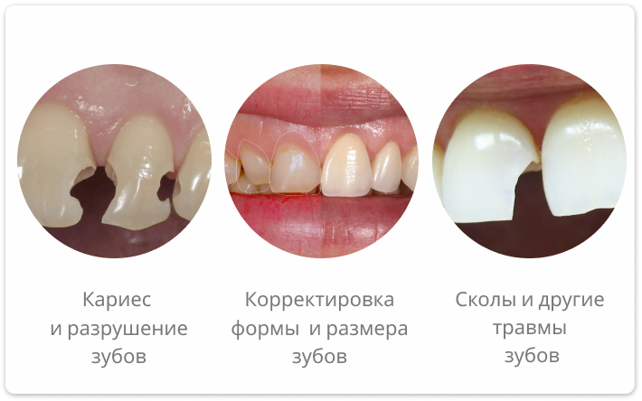 показания к наращиванию зубов