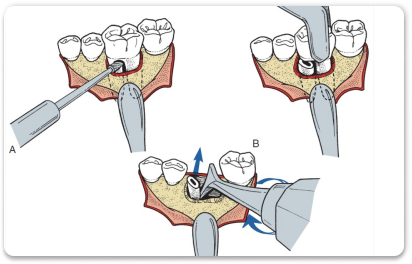 Удаление зуба по частям